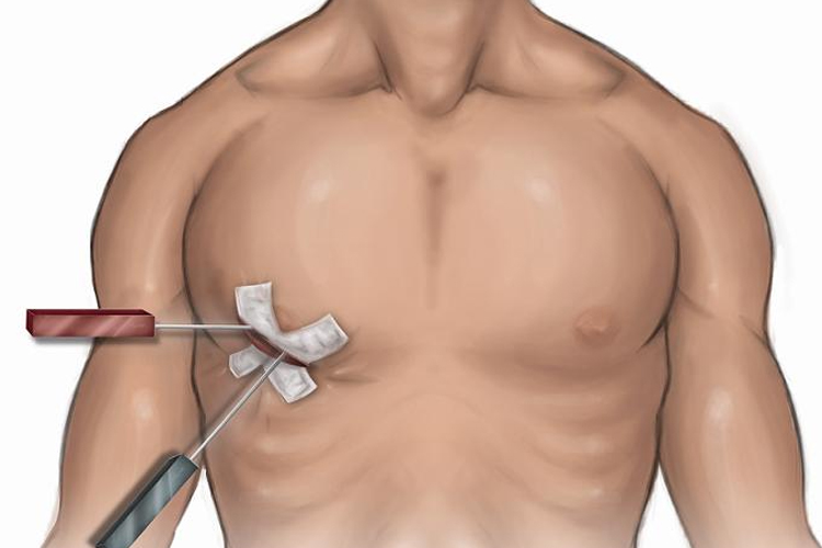 Minimal İnvaziv Kalp Cerrahisi ile Hızlı İyileşme